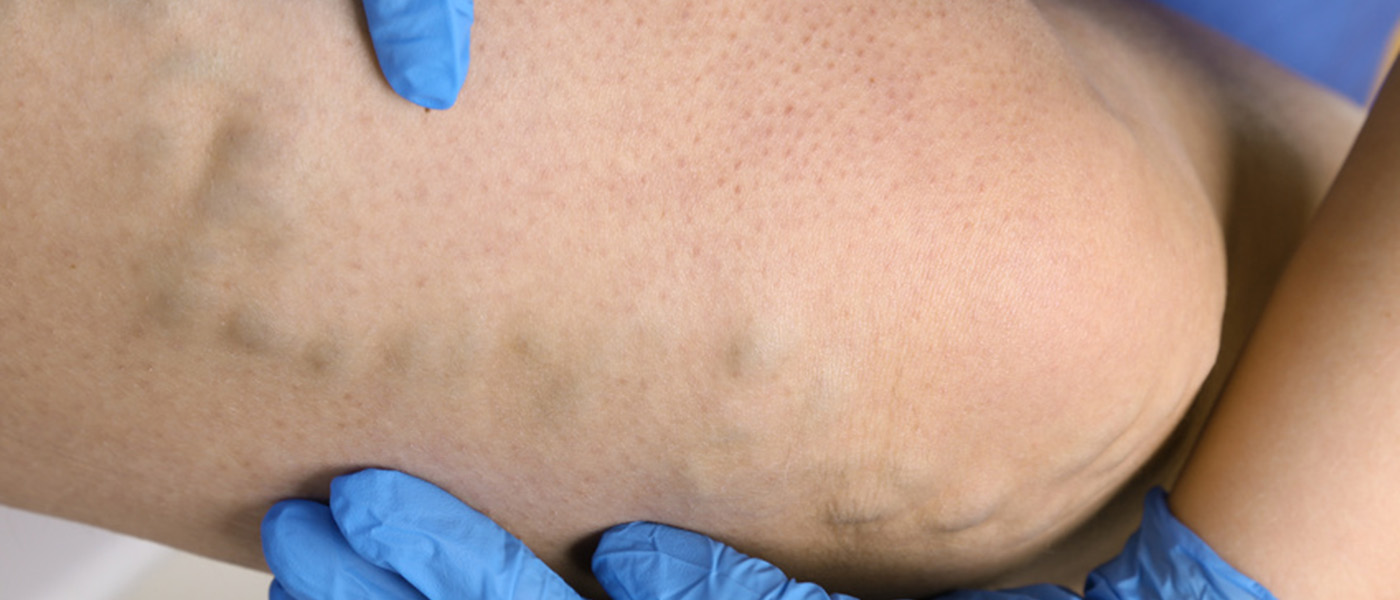 chirurgie des hemorroides