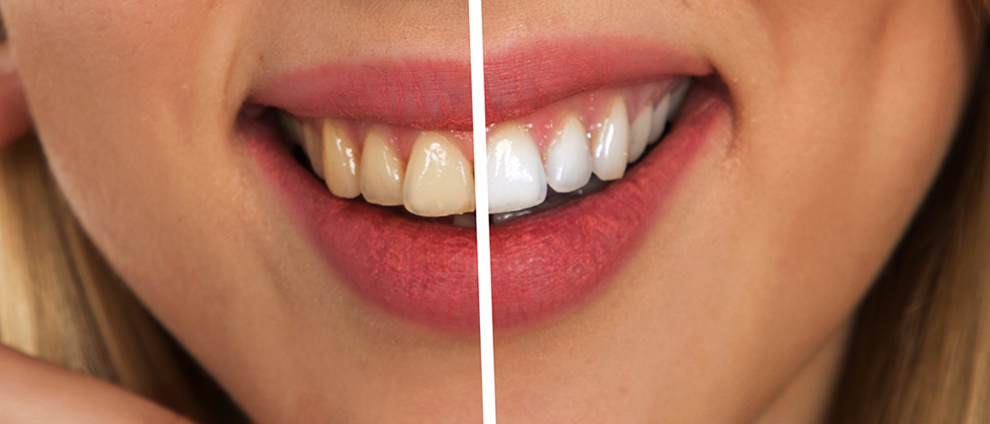 dents blanches