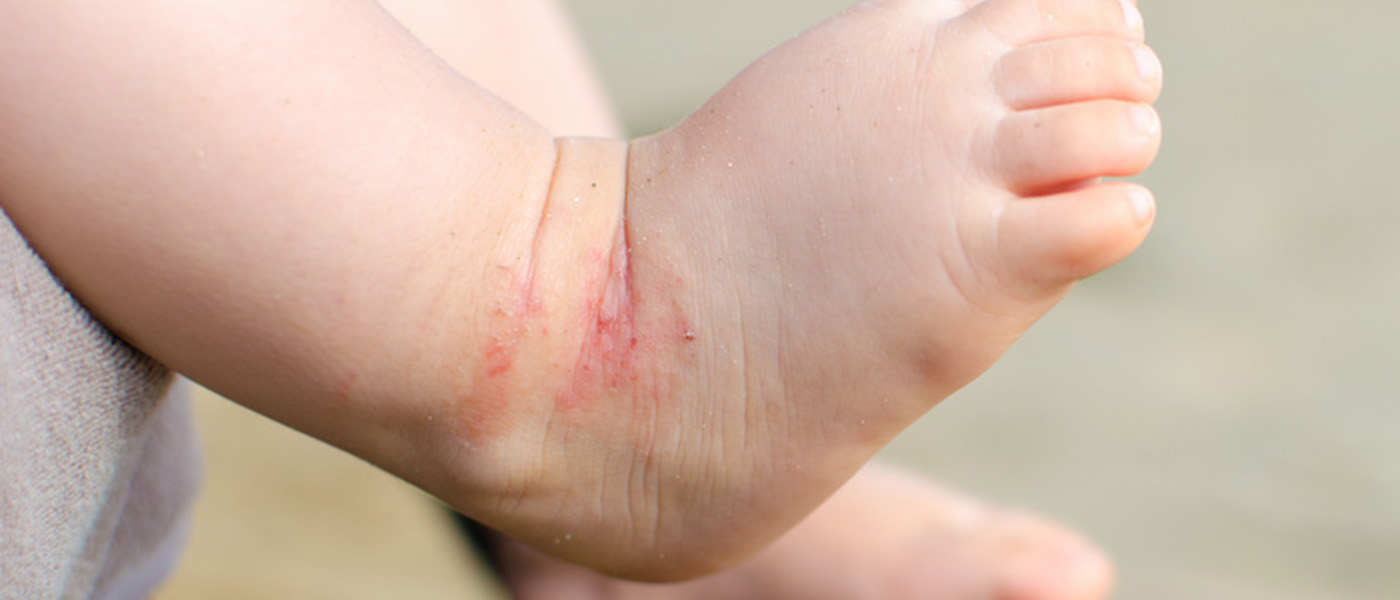 eczema de contact chez le bebe