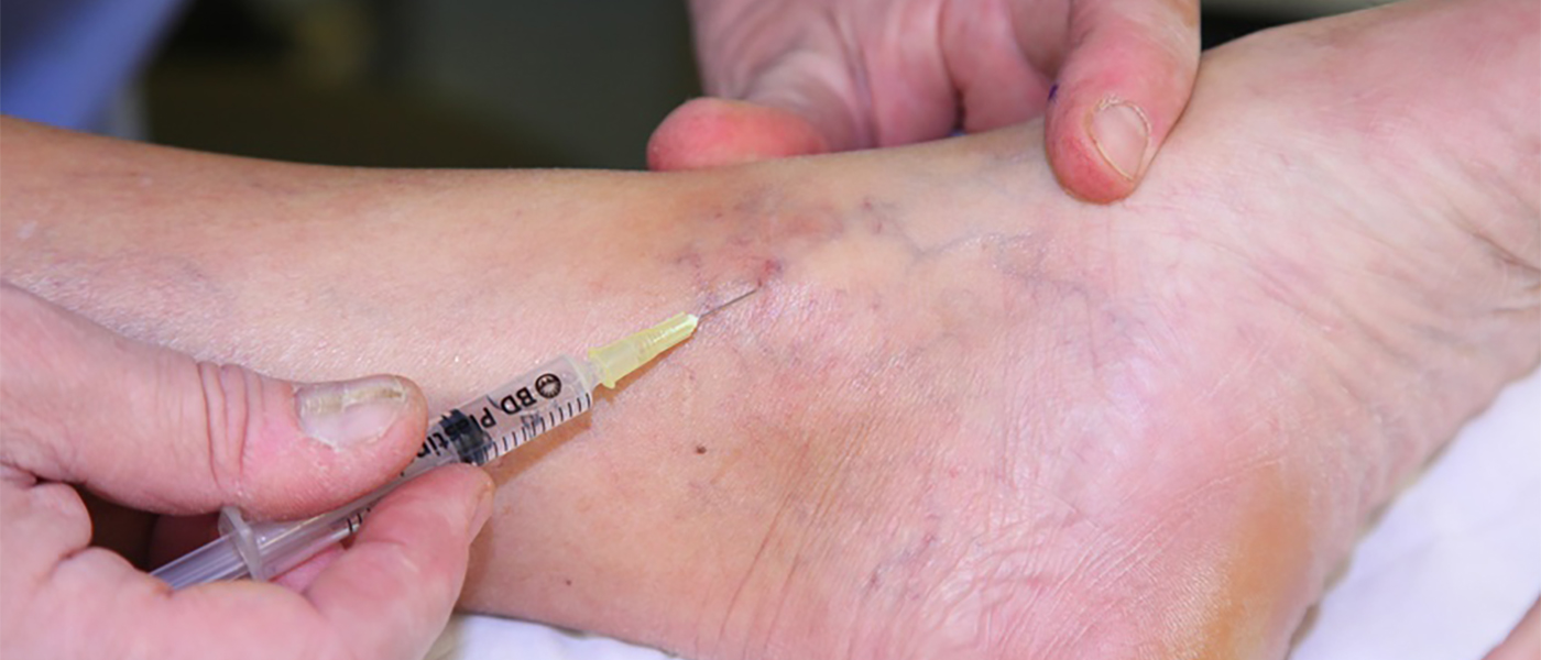 piquer des varices
