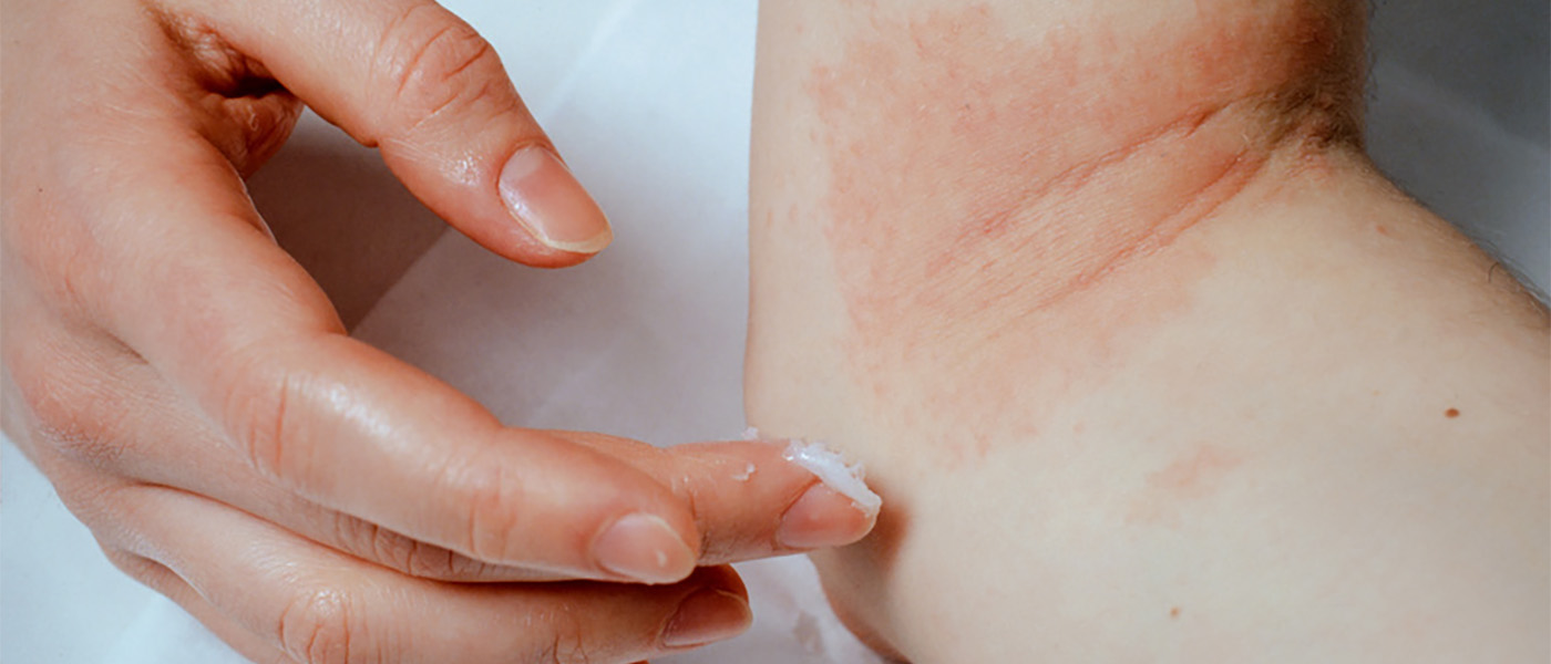 allergie cutanée : symptômes, causes et traitement