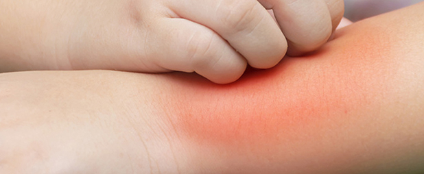 Dermatite Atopique Bebe Comment La Traiter Ou La Prevenir