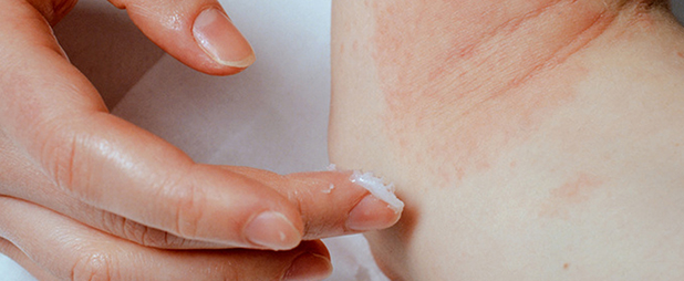 eczema adulte : Qu'est ce que l'eczéma chez l'adulte ?