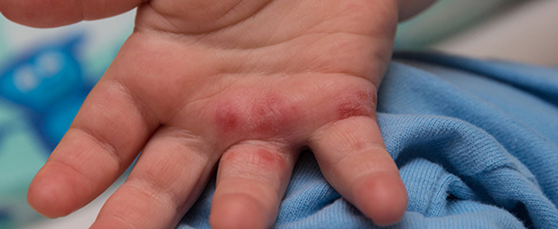 Eczema bébé : Comment soigner la dermatite atopique de bébé ?