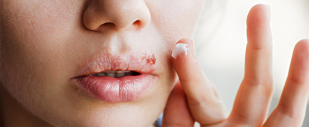 Comment soigner rapidement un bouton de fièvre sur la lèvre ?