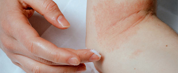 Quelles sont les causes du psoriasis ?