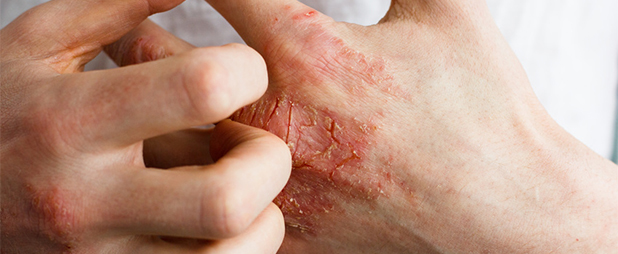 Psoriasis Pustuleux Comment Le Reconnaitre Et Le Soigner Psoriasis Pustuleux Comment Le Reconnaitre Et Le Soigner