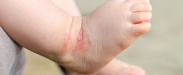 Psoriasis pied : Symptômes, causes et traitement