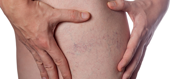 Comment faire disparaitre des varices ?