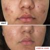 Centella Acne Care Soin acné et anti-imperfections Erborian - flacon de 30ml