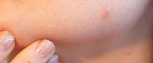 Huile essentielle acne