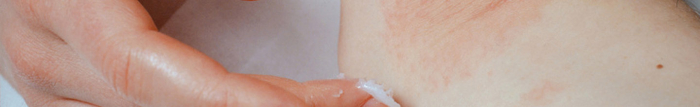 Qu'est ce que l'eczéma chez l'adulte ?