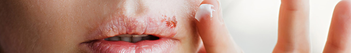 Comment soigner rapidement un bouton de fièvre sur la lèvre ?