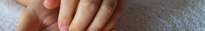 Qu'est-ce que le psoriasis en goutte ?